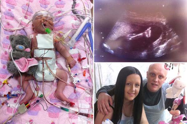 Just minutes after birth, doctors rushed the 7lb baby into an operating room to put a stent in her heart. She had hypoplastic left heart syndrome. One side of her heart wasn't beating.