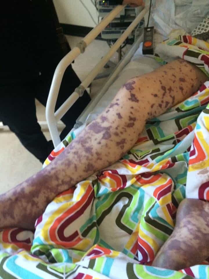 Brave Teen Shares Photos Of Herself With Meningitis To Raise Awareness