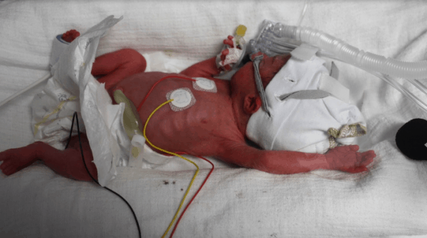 Baby Born 10 Weeks Premature Weighing Just 2lbs Is Finally