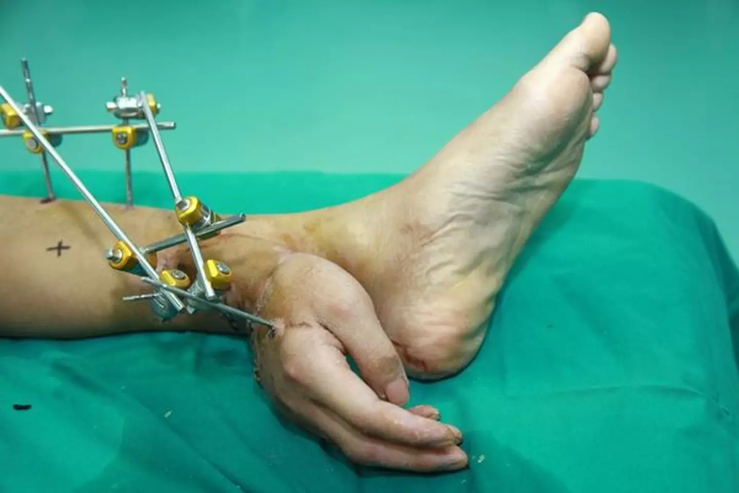 A man has had his hand attached to his ankle in China (STR/AFP via Getty Images)