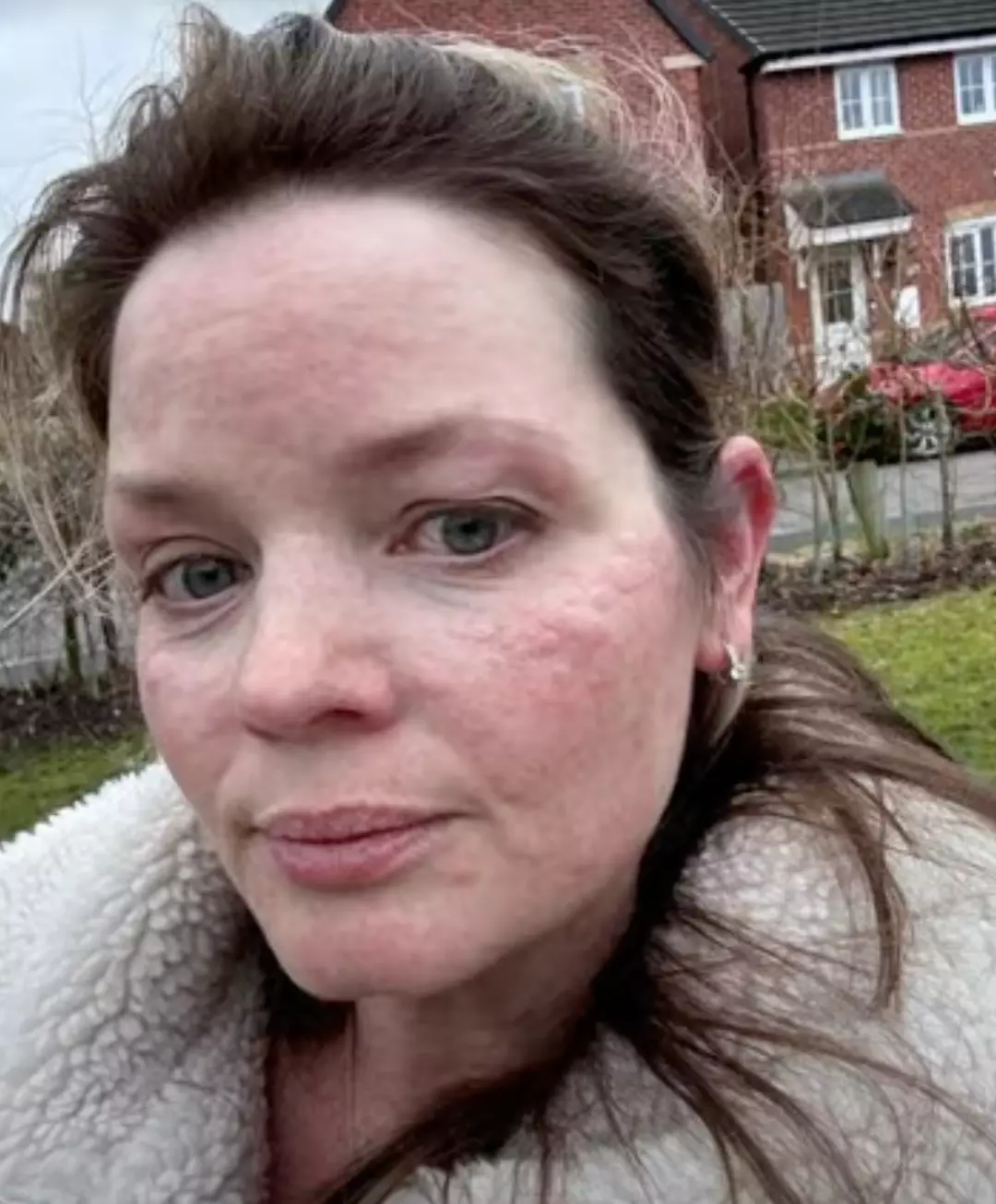 cold-induced urticaria essentially renders her 