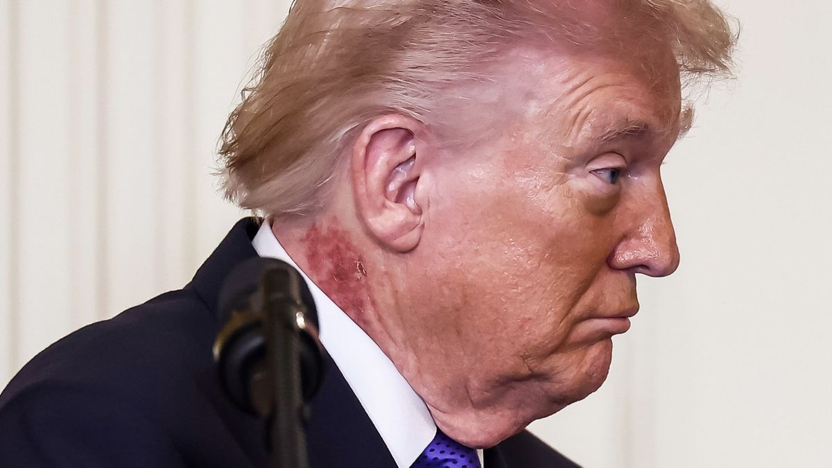 Donald Trump sparks fresh health concerns with scabbing neck rash - Pulptastic