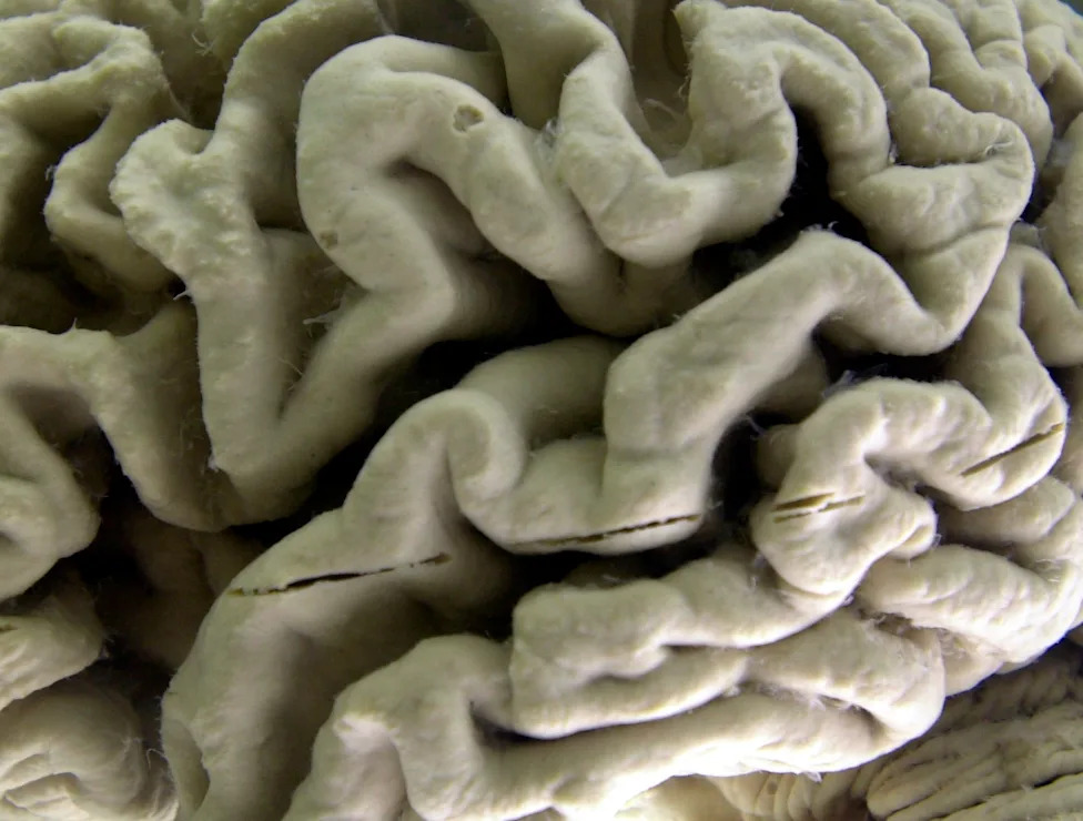 Study shows a blood test can help identify healthy people at high risk for Alzheimer’s disease