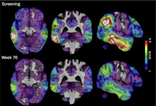 An experimental Alzheimer’s drug shows some promise as researchers hunt new approaches