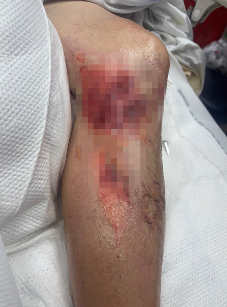 Las Vegas tourist set to have both legs amputated after tripping on scorching sidewalk that burned his body