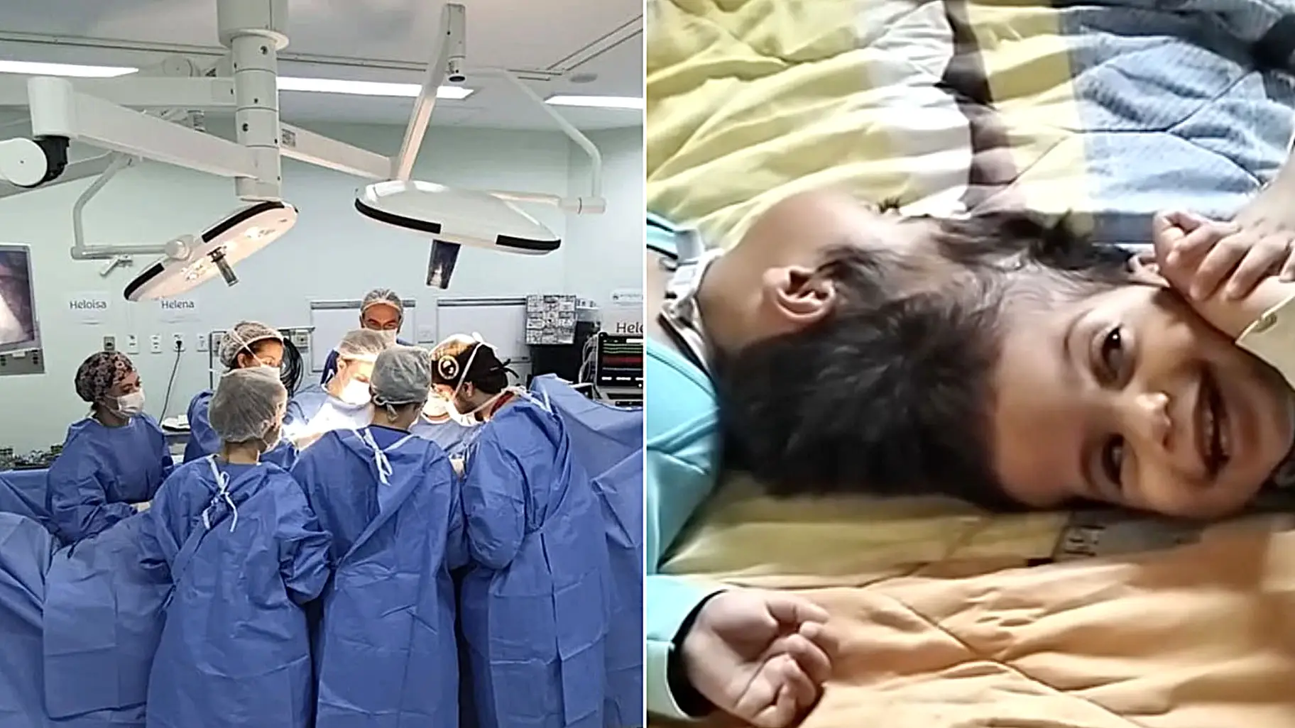 Conjoined twin girls, 2, die in desperate surgical operation minutes after being separated