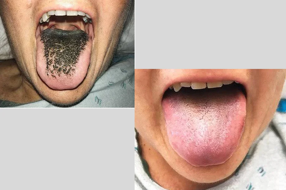 The little-known condition that can make your tongue look ‘hairy’ – and what it means for your health