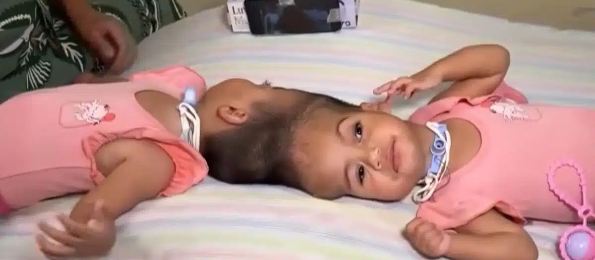Conjoined twin girls, 2, die in desperate surgical operation minutes after being separated