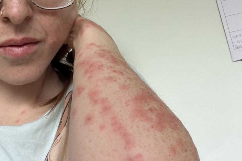 Travel influencer riddled with bleeding bed bug bites after one-night stay at popular international hotel: ‘Wouldn’t wish this on my worst enemy’