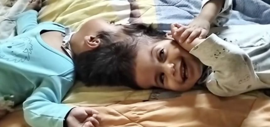 Conjoined twin girls, 2, die in desperate surgical operation minutes after being separated