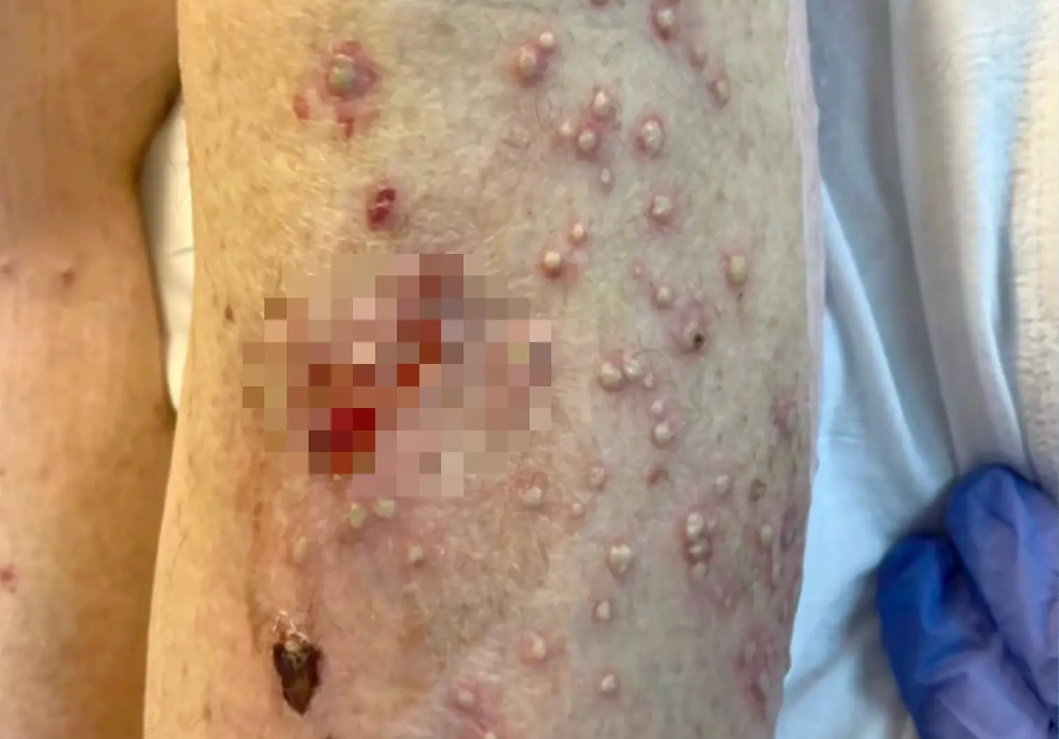 Family sues nursing home after elderly woman dies suffering nearly 1,000 ant bites