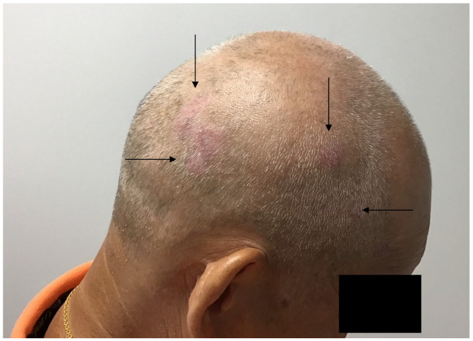 Doctor urges men to check their scalps for these little-known skin cancer signs