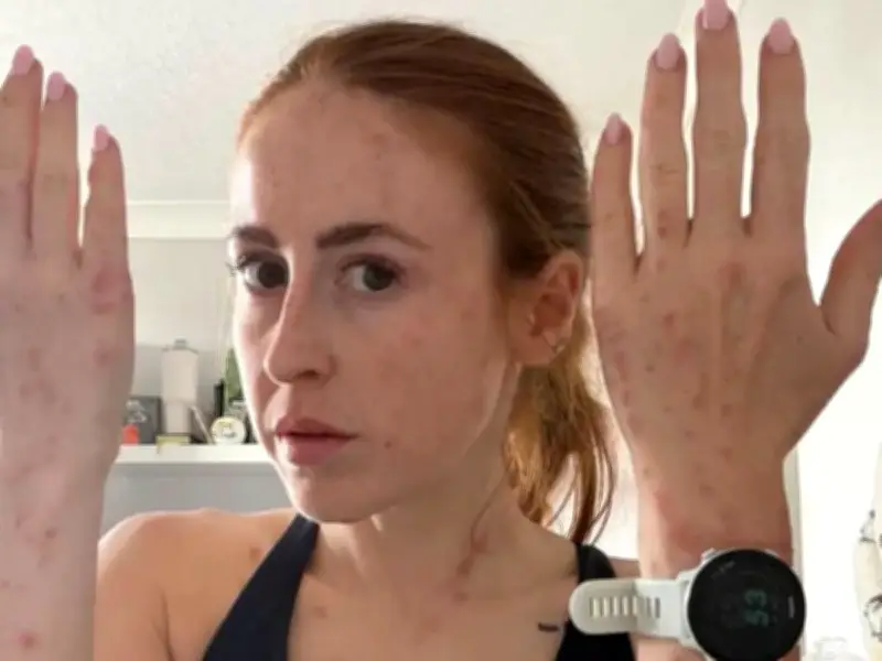 Travel influencer riddled with bleeding bed bug bites after one-night stay at popular international hotel: ‘Wouldn’t wish this on my worst enemy’