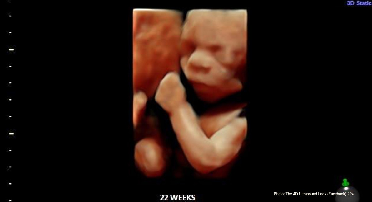 An Ontario couple's lawsuit against their surrogate over a disputed pregnancy termination request.