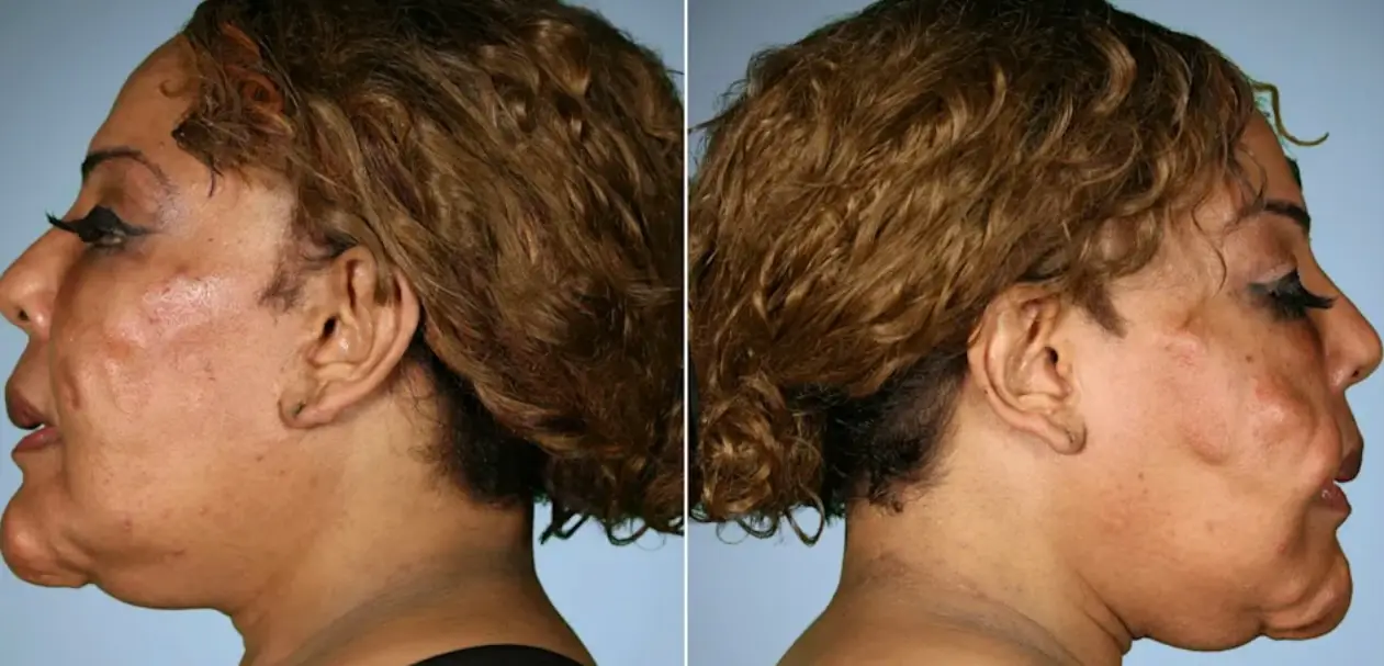 What happened to patient from TV show Botched who had 'concrete from hardware store' injected in face
