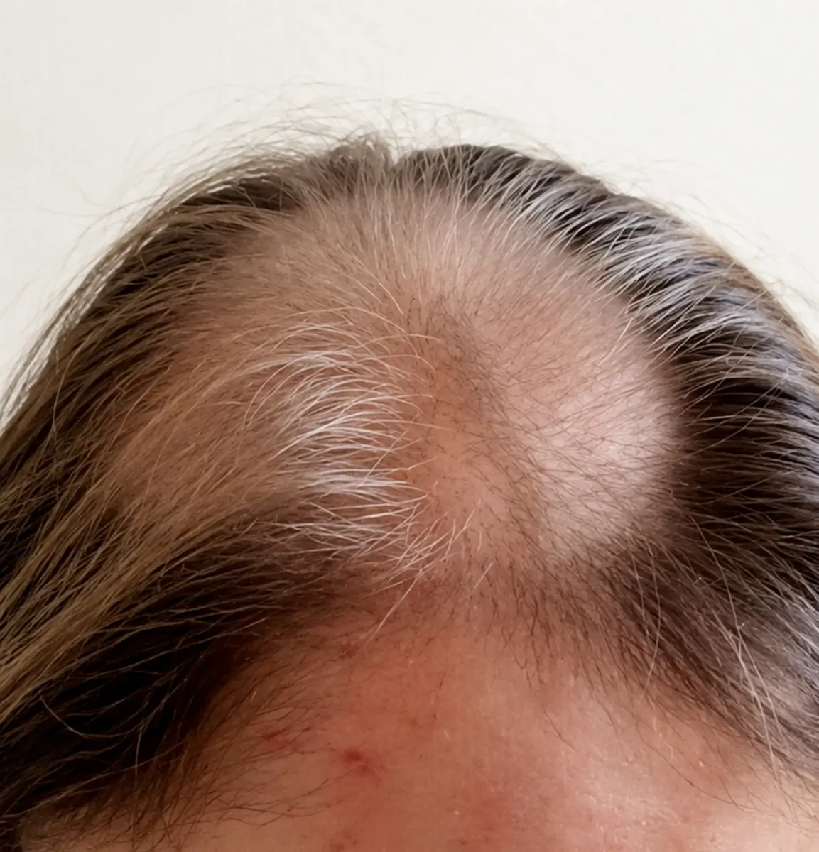 Woman spent 11 years undergoing chemotherapy for cancer she never actually had