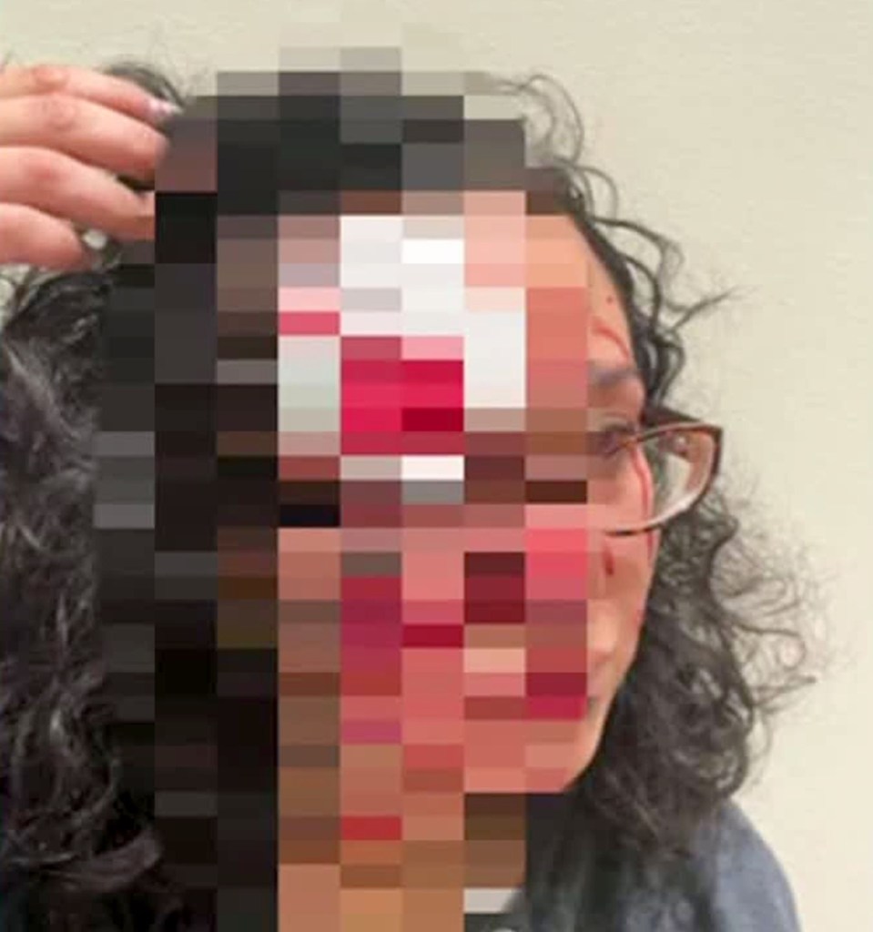 Woman accused of biting chunk out of victim’s forehead in ‘zombie bite’ attack