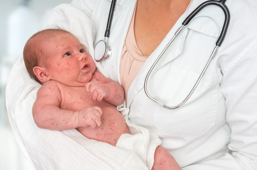 ‘We’re literally seeing new forms of measles’: Infectious disease doc warns about scary Pennsylvania development