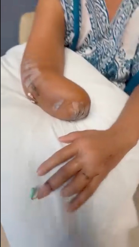 Florida alligator attack victim shares surprising update on her gruesome injuries: ‘Gator got a piece of me’