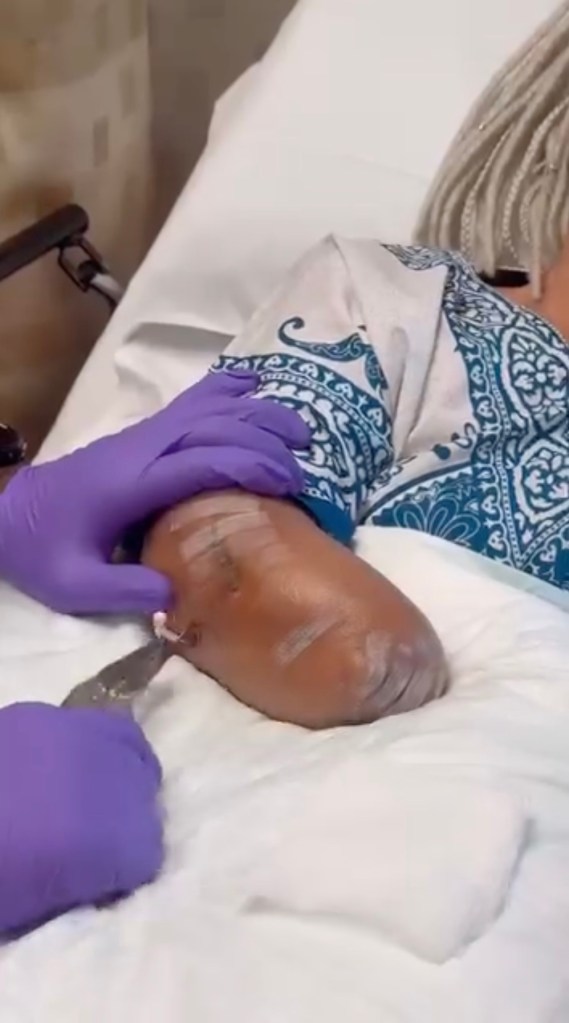 Florida alligator attack victim shares surprising update on her gruesome injuries: ‘Gator got a piece of me’