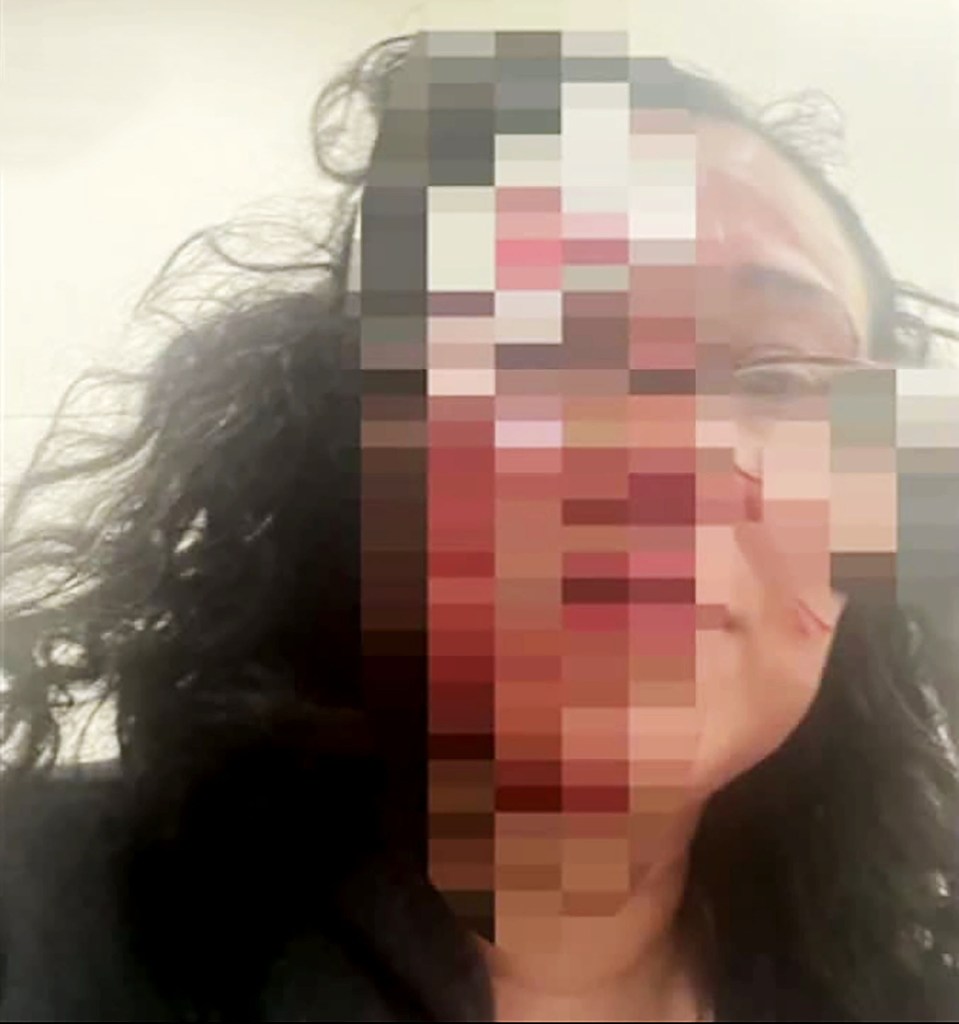 Woman accused of biting chunk out of victim’s forehead in ‘zombie bite’ attack