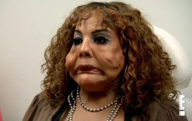 What happened to patient from TV show Botched who had 'concrete from hardware store' injected in face