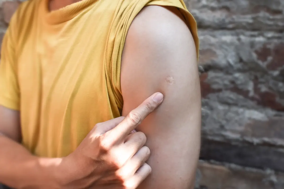 Reason why so many people have the same scar and what causes it as photos spark confusion