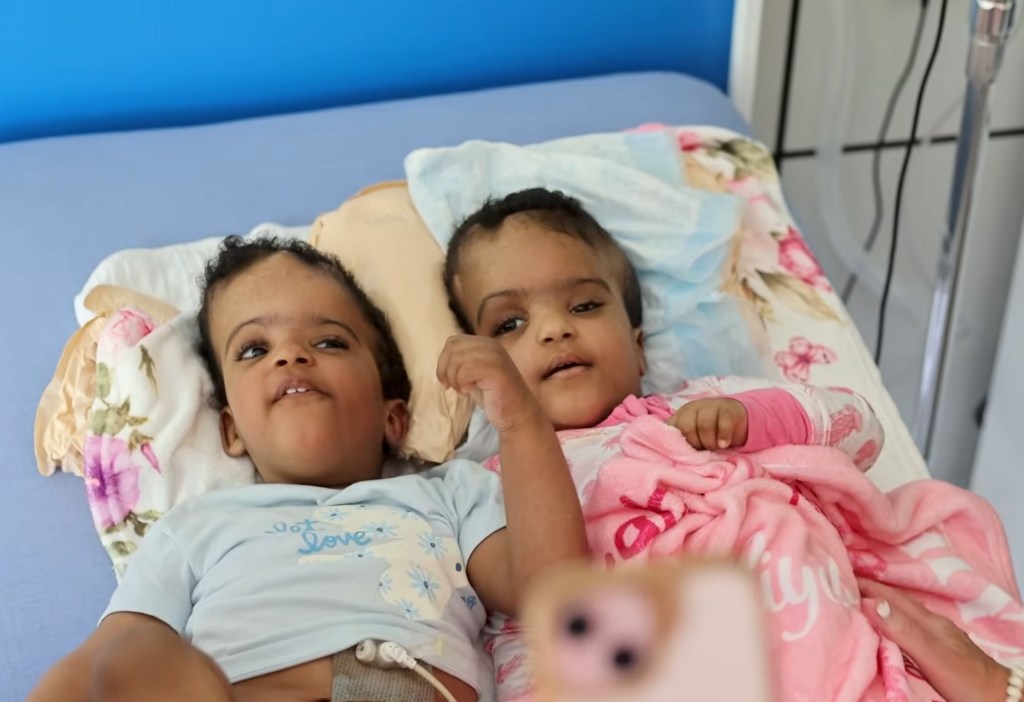 Conjoined twins attached at the head successfully separated after procedure requiring ‘sublime precision’