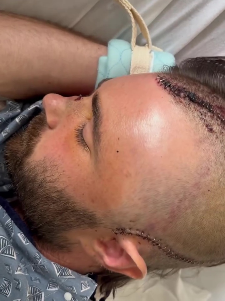 Netflix star who’d just had his big break left with horrific injuries after being hit by car at 100mph