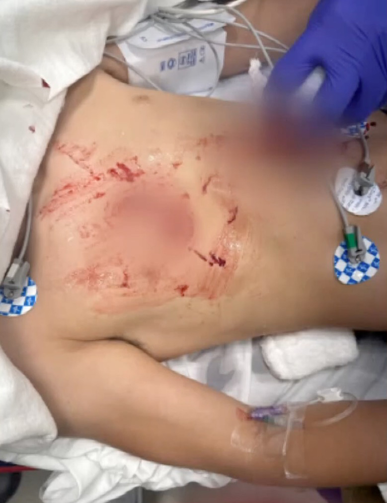 Boy, 13, attacked by rabid beaver at state park undergoes multiple surgeries