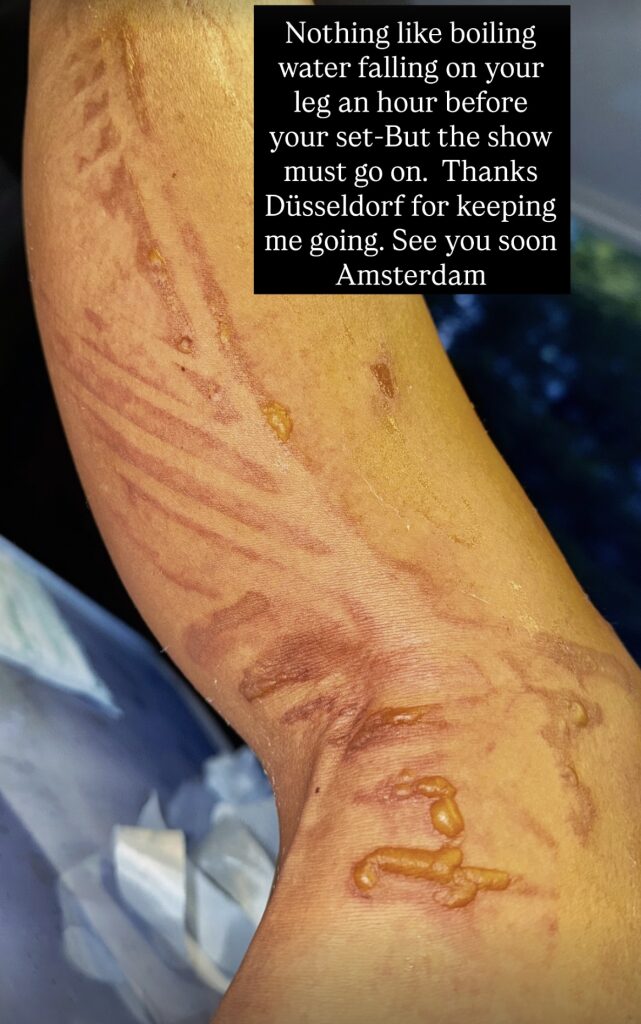 Nicole Scherzinger shows off gruesome injury after ‘boiling water’ fell on her leg 1 hour before concert