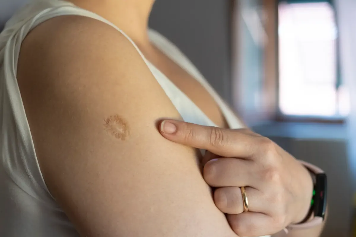 Reason why so many people have the same scar and what causes it as photos spark confusion
