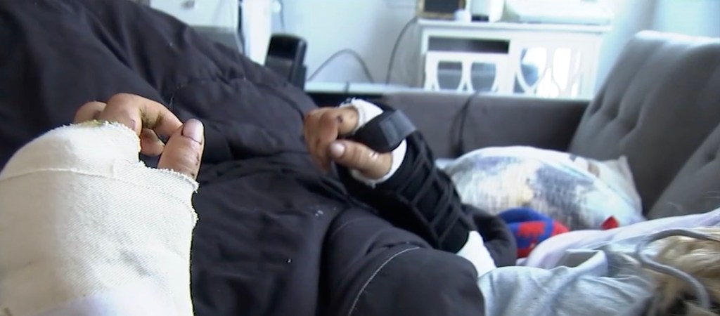 Woman horrifically mauled by massive pit bull in San Francisco reveals what really sparked attack