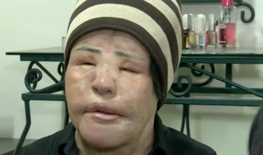 Model permanently disfigured after injecting cooking oil into her face when doctors refused more fillers