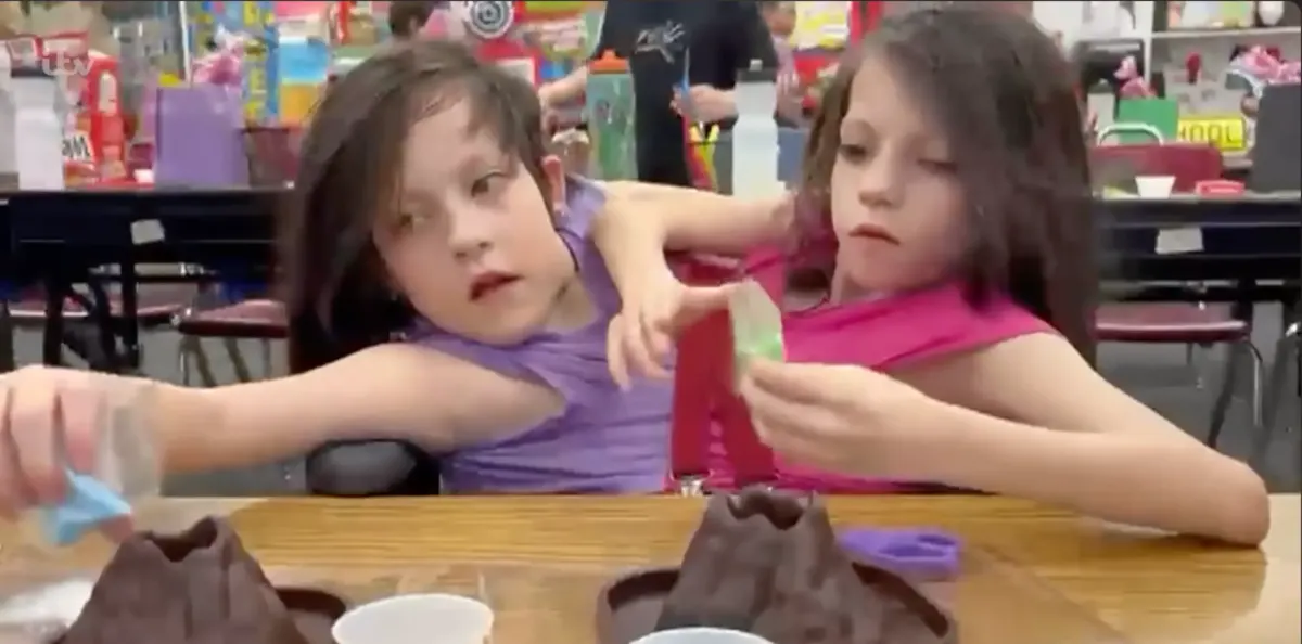 Mother of conjoined twins given just 24 hours to live reveals why she refused to separate them