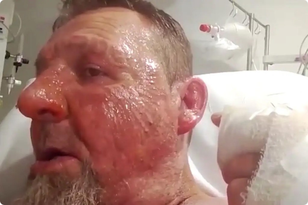 Hospital patient charged with attempted murder for setting another patient on fire