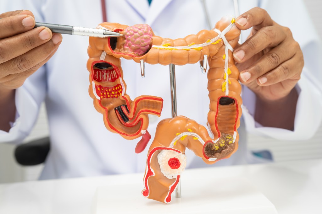 Colorectal cancer rates are rising among teens — new study finds 4 most common symptoms