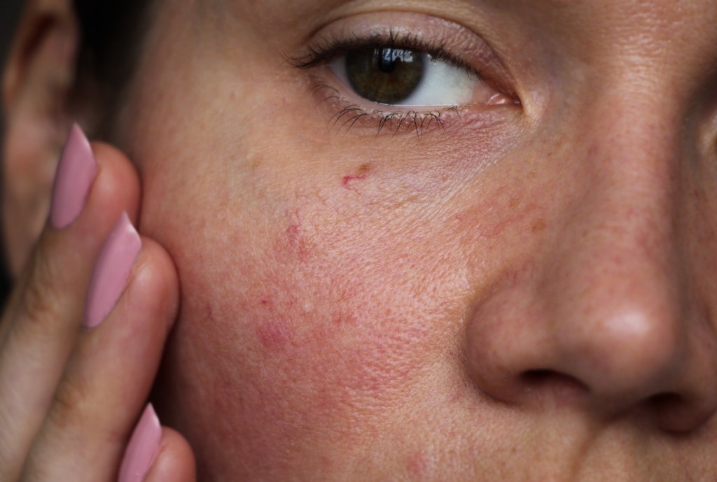 Kids and tweens are developing lifelong issues because of their skin care routines, warns derm — the No. 1 culprit